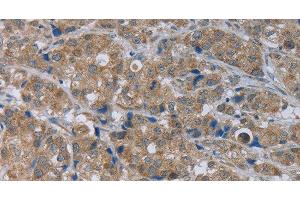 Immunohistochemistry of paraffin-embedded Human breast cancer using GABRB1 Polyclonal Antibody at dilution of 1:50 (GABRB1 anticorps)