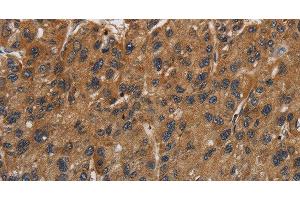 Immunohistochemistry of paraffin-embedded Human gastric cancer using ITGB7 Polyclonal Antibody at dilution of 1:40 (Integrin beta 7 anticorps)
