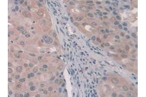 Detection of PCI in Human Breast Cancer Tissue using Polyclonal Antibody to Protein C Inhibitor (PCI)