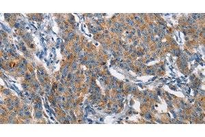 Immunohistochemistry of paraffin-embedded Human gastic cancer using CHMP1A Polyclonal Antibody at dilution of 1:60