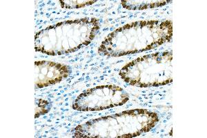 Immunohistochemistry of paraffin-embedded Human appendix using CDX2 antibody  at dilution of 1:300 (40x lens).