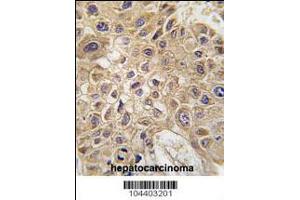 Formalin-fixed and paraffin-embedded human hepatocarcinoma tissue reacted with AMFR Antibody , which was peroxidase-conjugated to the secondary antibody, followed by DAB staining.