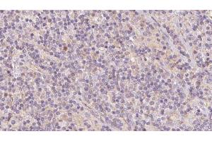 ABIN6273101 at 1/100 staining Human lymph cancer tissue by IHC-P. (CKMT1 anticorps  (N-Term))