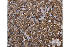 Immunohistochemistry of Human thyroid cancer using GSTP1 Polyclonal Antibody at dilution of 1:60 (GSTP1 anticorps)