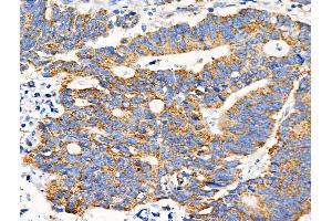 ABIN6258879 and ABIN6274499 at 1/100 staining Human colorectal cancer by IHC-P.