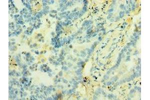 Immunohistochemistry of paraffin-embedded human lung cancer using ABIN7171227 at dilution of 1:100 (Syntaxin 12 anticorps  (AA 1-250))