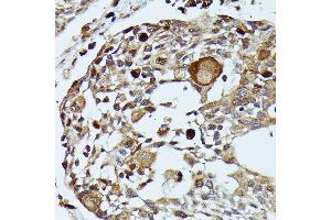 Immunohistochemistry of paraffin-embedded human esophageal cancer using MEKK3 antibody (ABIN7268652) at dilution of 1:100 (40x lens).
