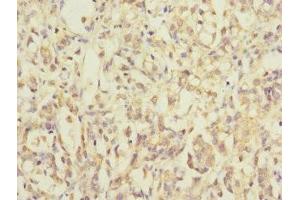 Immunohistochemistry of paraffin-embedded human gastric cancer using ABIN7142352 at dilution of 1:100 (MRPL12 anticorps  (AA 1-198))