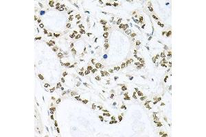 Immunohistochemistry of paraffin-embedded human gastric cancer using BCCIP antibody.