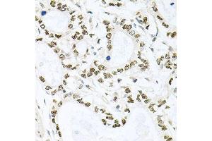 Immunohistochemistry of paraffin-embedded human gastric cancer using BCCIP antibody. (BCCIP anticorps  (AA 1-314))