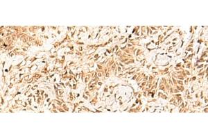 Immunohistochemistry of paraffin-embedded Human ovarian cancer tissue using HNF4A Polyclonal Antibody at dilution of 1:40(x200) (HNF4A anticorps)