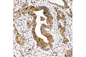 Anti-Integrin alpha 3 antibody, IHC(P) IHC(P): Human Intestinal Cancer Tissue (ITGA3 anticorps  (N-Term))