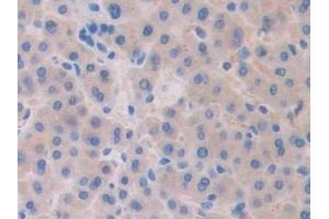 Detection of Slit1 in Human Liver cancer Tissue using Polyclonal Antibody to Slit Homolog 1 (Slit1) (SLIT1 anticorps  (AA 647-835))