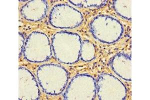 Immunohistochemistry of paraffin-embedded human gastric cancer using ABIN7153143 at dilution of 1:100 (CX3CL1 anticorps  (AA 25-100))