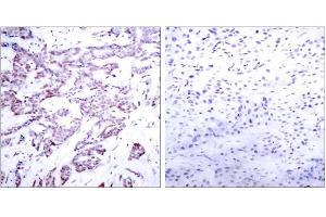 Immunohistochemical analysis of paraffin-embedded human breast carcinoma tissue using STAT6 (phospho-Thr645) antibody (E011051). (STAT6 anticorps  (pThr645))
