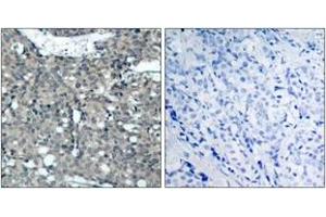 Immunohistochemistry analysis of paraffin-embedded human breast carcinoma tissue, using Paxillin (Ab-118) Antibody.