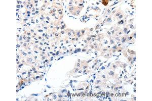 Immunohistochemistry of Human lung cancer using IGFBP7 Polyclonal Antibody at dilution of 1:25 (IGFBP7 anticorps)