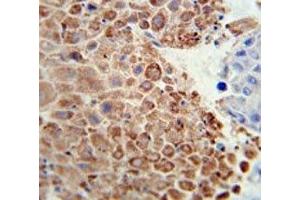 PHGDH antibody immunohistochemistry analysis in formalin fixed and paraffin embedded human hepatocarcinoma.