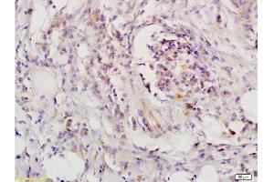 Formalin-fixed and paraffin-embedded human colon carcinoma labeled with Rabbit Anti-CD118 Polyclonal Antibody , Unconjugated 1:200 followed by conjugation to the secondary antibody and DAB staining