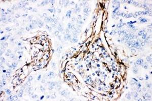 IHC-P: Caveolin-1 antibody testing of human lung cancer tissue.