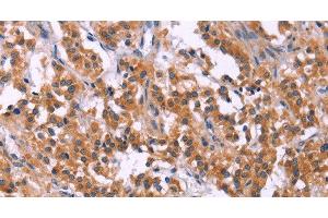 Immunohistochemistry of paraffin-embedded Human thyroid cancer tissue using MSMO1 Polyclonal Antibody at dilution 1:40 (SC4MOL anticorps)
