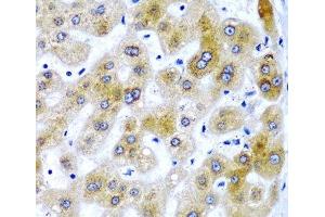 Immunohistochemistry of paraffin-embedded Human liver damage using SECISBP2 Polyclonal Antibody at dilution of 1:200 (40x lens). (SECISBP2 anticorps)