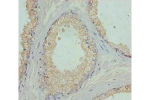 Immunohistochemistry of paraffin-embedded human prostate cancer using ABIN7152449 at dilution of 1:100 (FBXO7 anticorps  (AA 353-522))