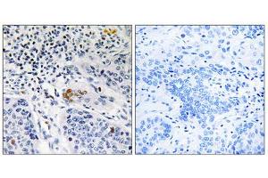 Immunohistochemistry analysis of paraffin-embedded human lung carcinoma tissue, using ZBTB40 antibody. (ZBTB40 anticorps  (C-Term))