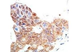 IHC analysis of FFPE human breast carcinoma tissue stained with the PRMT5 antibody (PRMT5 anticorps  (AA 591-621))