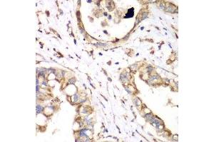 Immunohistochemistry of paraffin-embedded human liver cancer using HADHA antibody. (HADHA anticorps  (AA 484-763))