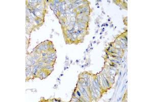 Immunohistochemistry of paraffin-embedded human colon carcinoma using KRBOX4 antibody (ABIN5975027) at dilution of 1/200 (40x lens). (KRAB Box Domain Containing 4 (KRBOX4) anticorps)