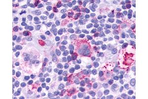 Anti-Leukotriene B4 Receptor / BLT1 antibody IHC of human Lymph Node, Hodgkins Lymphoma.