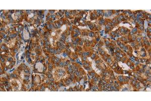 Immunohistochemistry of paraffin-embedded Human thyroid cancer using MRPL39 Polyclonal Antibody at dilution of 1:45