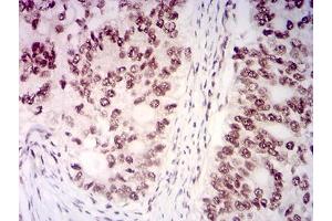 Immunohistochemical analysis of paraffin-embedded cervical cancer tissues using KMT2D mouse mAb with DAB staining.
