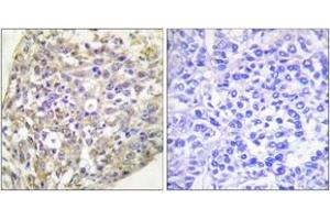 Immunohistochemistry analysis of paraffin-embedded human breast carcinoma, using HSP90B (Phospho-Ser254) Antibody.