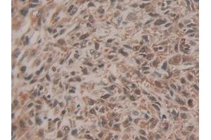 Detection of EZH2 in Human Lung cancer Tissue using Polyclonal Antibody to Enhancer Of Zeste Homolog 2 (EZH2)