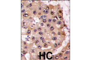 Formalin-fixed and paraffin-embedded human hepatocellular carcinoma reacted with PSMA5 polyclonal antibody  , which was peroxidase-conjugated to the secondary antibody, followed by DAB staining.