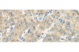 Immunohistochemistry of paraffin-embedded Human liver cancer tissue using VPS4A Polyclonal Antibody at dilution 1:40 (VPS4A anticorps)