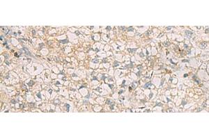 Immunohistochemistry of paraffin-embedded Human liver cancer tissue using SLC30A6 Polyclonal Antibody at dilution of 1:70(x200) (SLC30A6 anticorps)