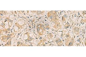 Immunohistochemistry of paraffin-embedded Human liver cancer tissue using ZDHHC3 Polyclonal Antibody at dilution of 1:35(x200) (ZDHHC3 anticorps)