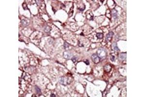 IHC analysis of FFPE human hepatocarcinoma tissue stained with the ALK1 antibody