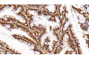 Detection of GAPDH in Human Colorectal cancer Tissue using Anti-Glyceraldehyde-3-Phosphate Dehydrogenase (GAPDH) Monoclonal Antibody