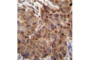 mmunohistochemistry analysis in human breast carcinoma (formalin-fixed, paraffin-embedded) using Sorting nexin-24 (SNX24)  Antibody (N-term), followed by peroxidase conjugation of the secondary antibody and DAB staining. (SNX24 anticorps  (N-Term))