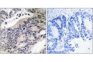 Immunohistochemistry analysis of paraffin-embedded human colon carcinoma tissue, using ACSS1 Antibody. (ACSS1 anticorps)