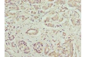 Immunohistochemistry of paraffin-embedded human pancreatic cancer using ABIN7156043 at dilution of 1:100 (FcRn anticorps  (AA 24-297))