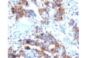 IHC testing of human gastric carcinoma stained with MUC5AC antibody (45M1). (MUC5AC anticorps)