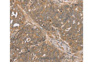 Immunohistochemistry of Human ovarian cancer using PTPN20B Polyclonal Antibody at dilution of 1:30 (PTPN20 anticorps)