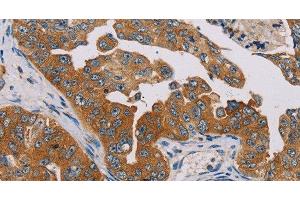 Immunohistochemistry of paraffin-embedded Human cervical cancer tissue using MBNL3 Polyclonal Antibody at dilution 1:30 (MBNL3 anticorps)