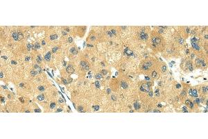 Immunohistochemistry of paraffin-embedded Human liver cancer using TRIM10 Polyclonal Antibody at dilution of 1/35 (TRIM10 anticorps)