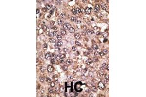 Formalin-fixed and paraffin-embedded human cancer tissue reacted with the primary antibody, which was peroxidase-conjugated to the secondary antibody, followed by DAB staining.